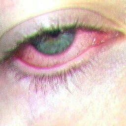 glaucoma