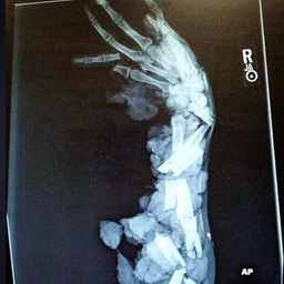 bone